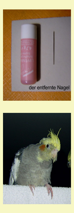 Nagel im Bein und der Fu nach Ziehung des Nagels.